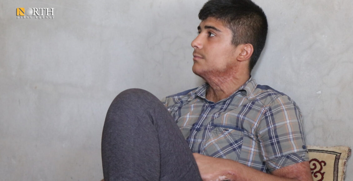 Muhammad Hamid, a child injured in Turkish attacks on the city of Sere Kaniye (Ras al-Ain), northeast Syria - North Press