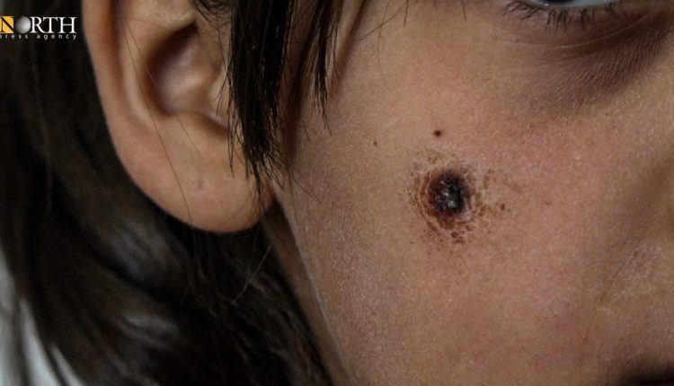 A leishmaniasis nodule on a girl's cheek from the countryside of Manbij, northern Syria – North Press